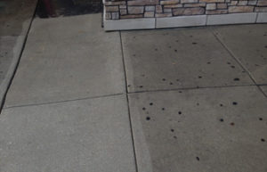 Gum Removal Houston - Thumb